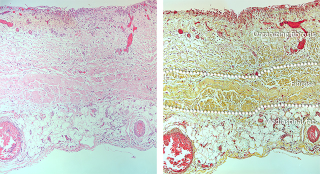 Organizing pericarditis micro H&E and Movat